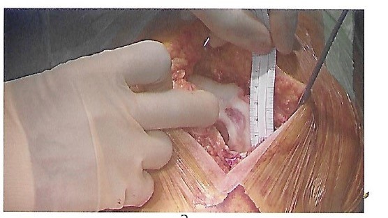 Case 2 – Area of damage in femur being measured Case 2 - Area of damage in femur being measured