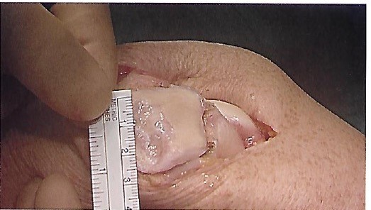 Damage in the kneecap being measured Damage in the kneecap being measured